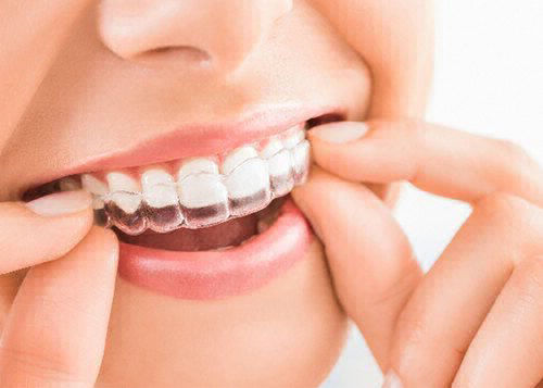 TrioClear aligners
